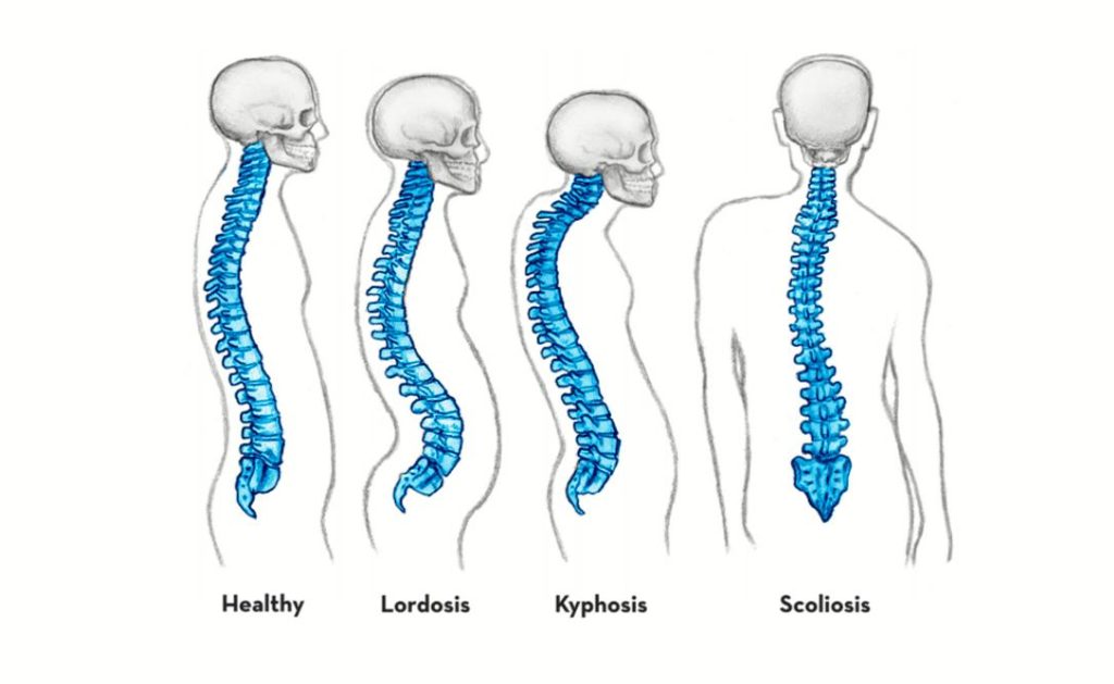 illustration of spine shapes. from: PWCD - contortionism /